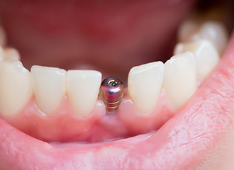 titanium-dental-implant Titanium Dental Implant